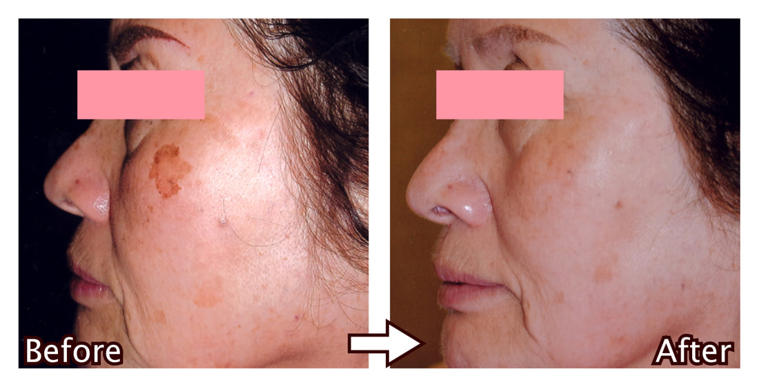 IPL照射＋RF(ラジオ波)照射コース