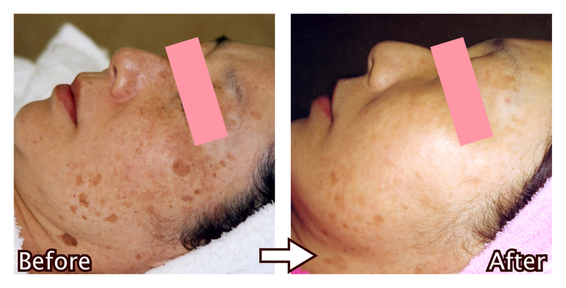 IPL照射＋RF(ラジオ波)照射コース