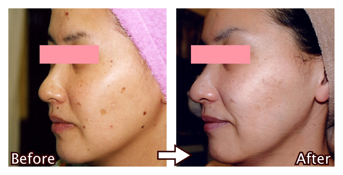 IPL全顔コース（女性）