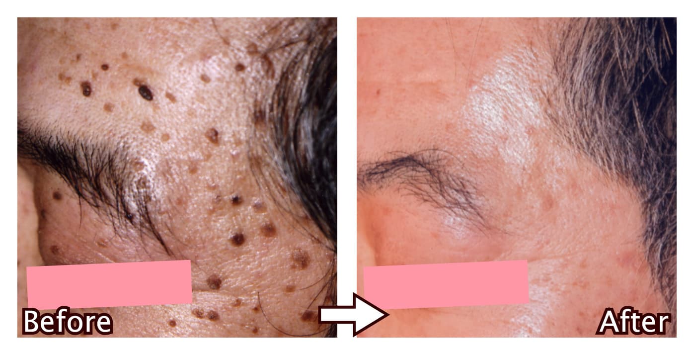 IPL全顔コース（男性）