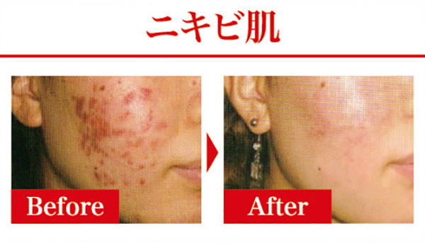ニキビ肌のBefore&After